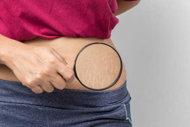 Post Natal Care: How to Get Rid of Stretch Mark